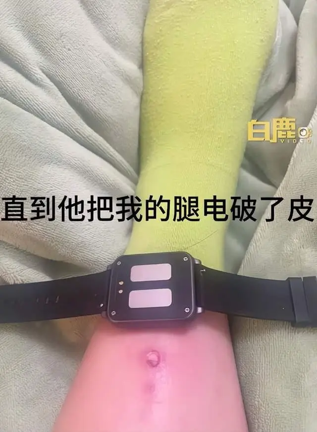 中國女大生為了早起使用電擊手錶並設置最高 480V 電壓，結果睡死導致腳踝燒傷破皮 - 電腦王阿達